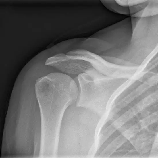x-ray right shoulder oblique view test